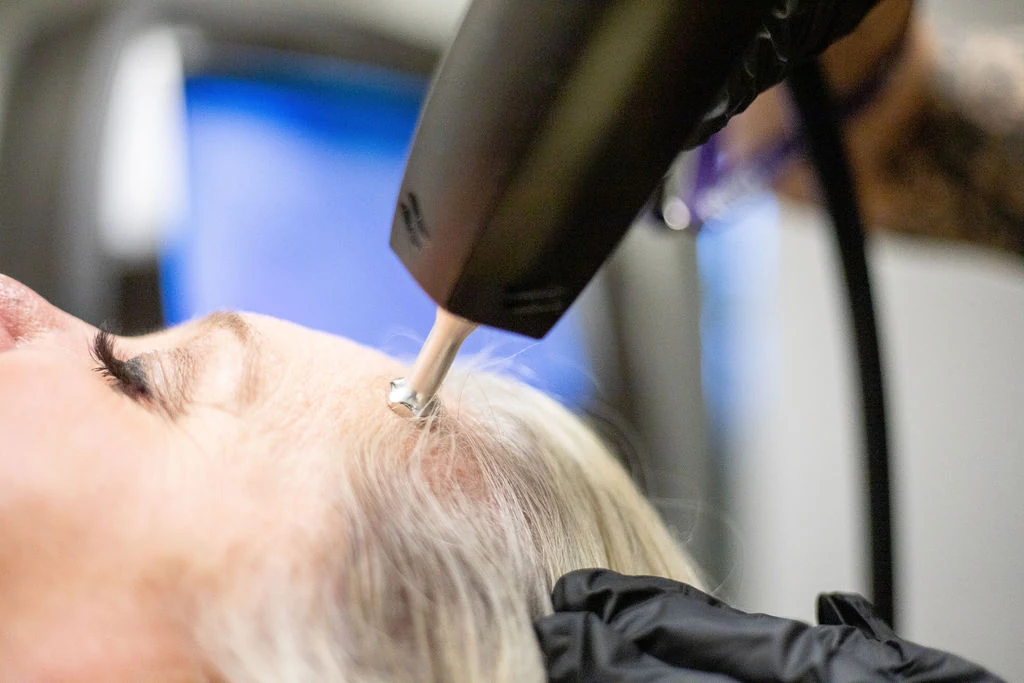 Alma TED treatment at Another Look Hair Institute
