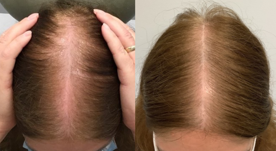Before and after hair part density comparison