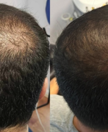 Before and after crown density comparison