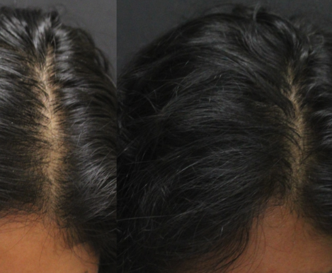 Before and after hair part fullness comparison
