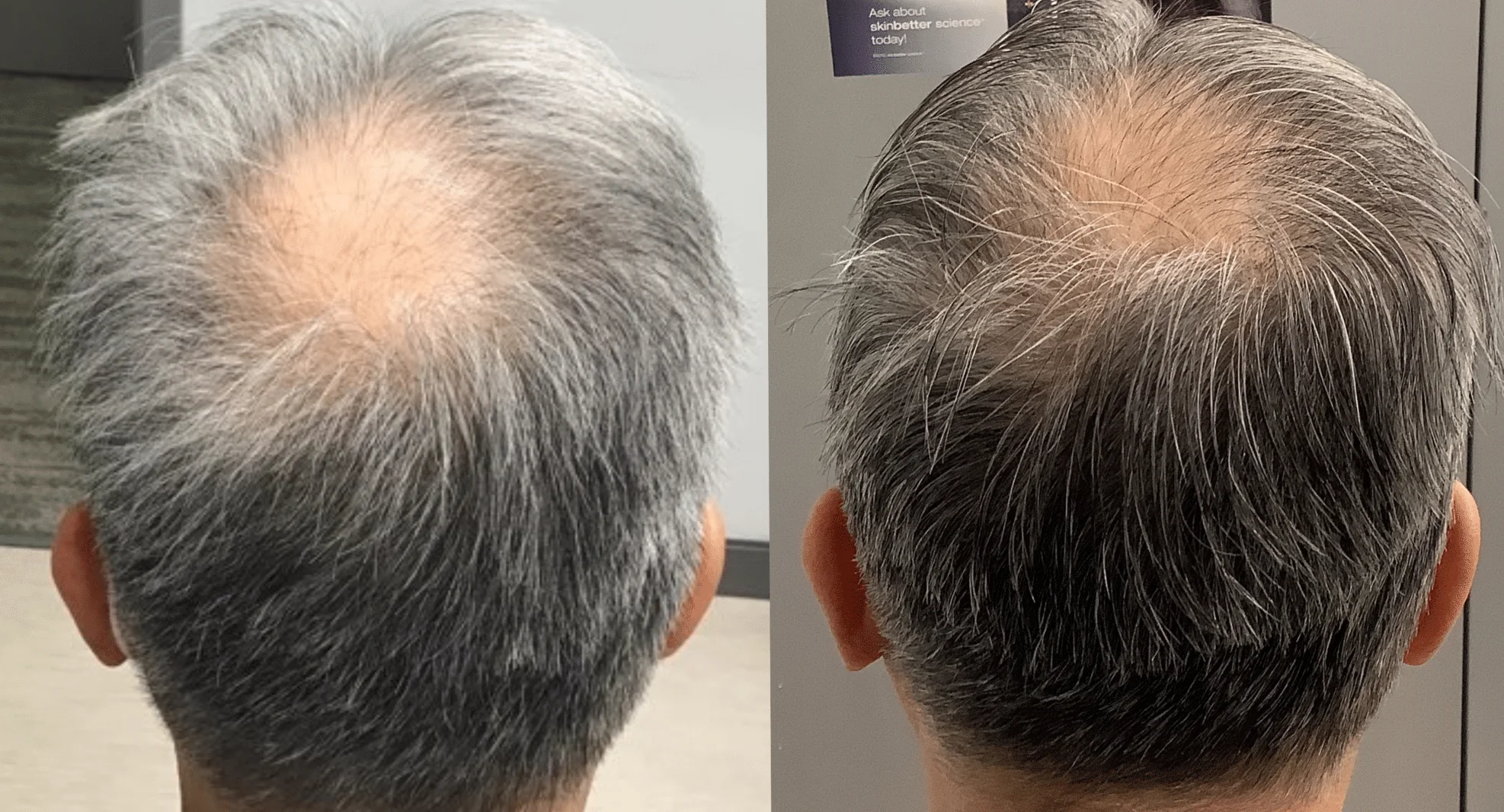 Before and after hair density example