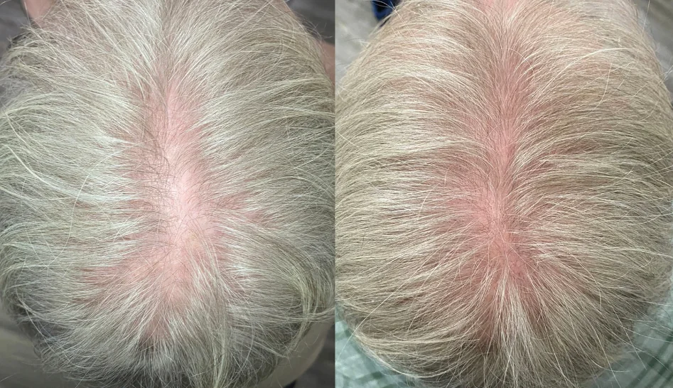 Before and after scalp density example